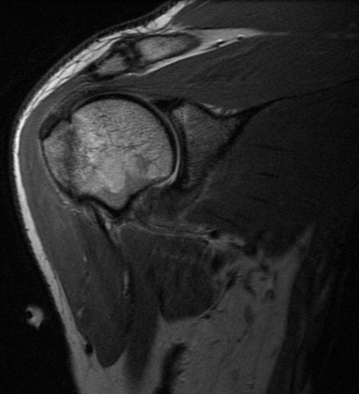 Figure 3 for case Greater tuberosity fracture and capsular sprain